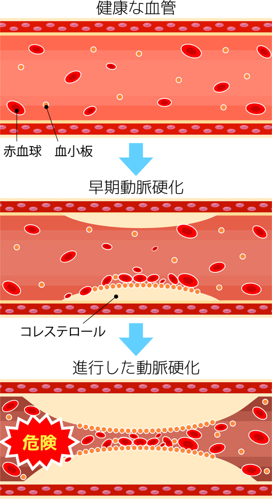 症 は 異常 脂質 と コロナワクチンに関する基礎疾患の定義について ／なかはら内科クリニック